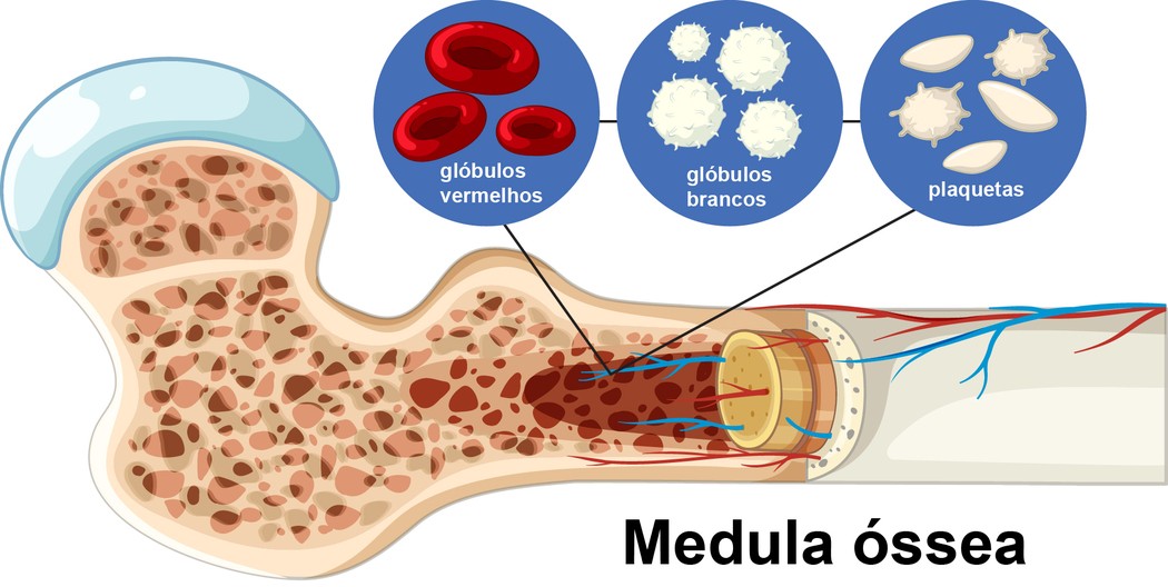 Ilustração da medula óssea em corte de osso, com destaque para glóbulos vermelhos, glóbulos brancos e plaquetas, ilustrando conteúdo sobre leucemia sintomas