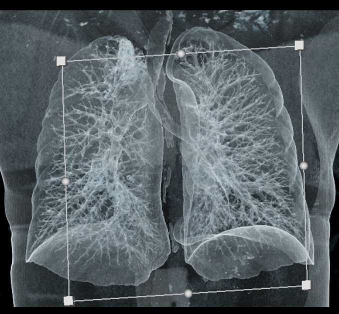 Reconstrução tridimensional (3D) dos pulmões e da árvore brônquica obtida a partir de um exame de tomografia de tórax, destacando a complexidade e os detalhes da anatomia respiratória interna.