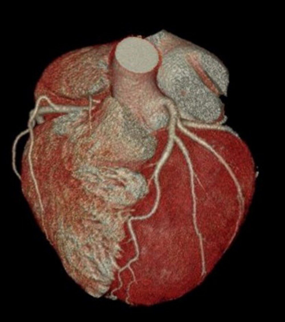Imagem tridimensional do coração obtida por tomografia computadorizada, mostrando vasos sanguíneos e estruturas cardíacas, ilustrando artigo sobre tomografia o que é e para que serve.
