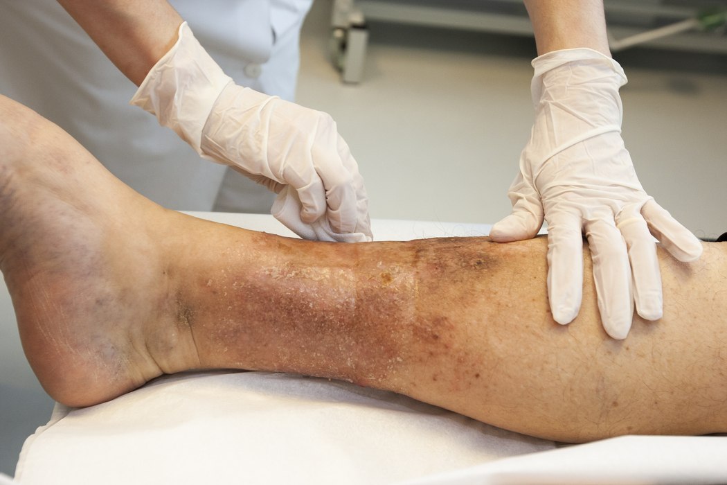 Perna de paciente com sequelas da síndrome pós-trombótica após trombose, apresentando inchaço e manchas escuras, sendo examinada por profissional de saúde com luvas.